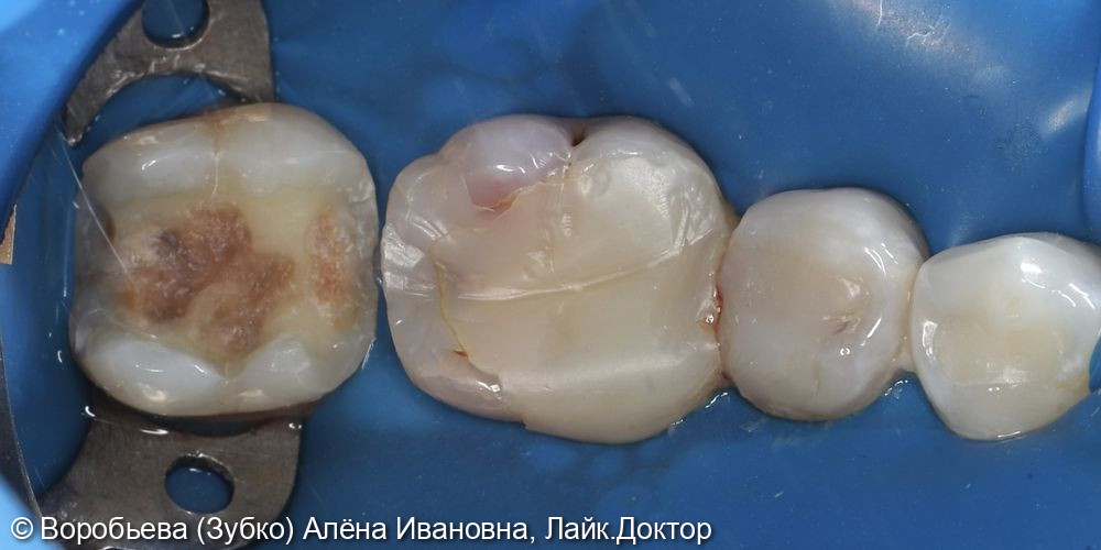 Лечение пульпита 37 зуба фото 2 · Вологда