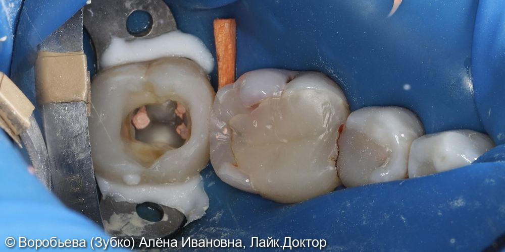 Лечение пульпита 37 зуба фото 3 · Вологда