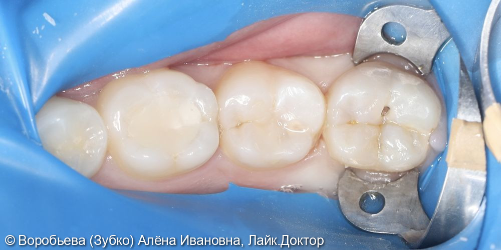 Лечение глубокого кариеса 46,47 и 48 зуба - фото №1