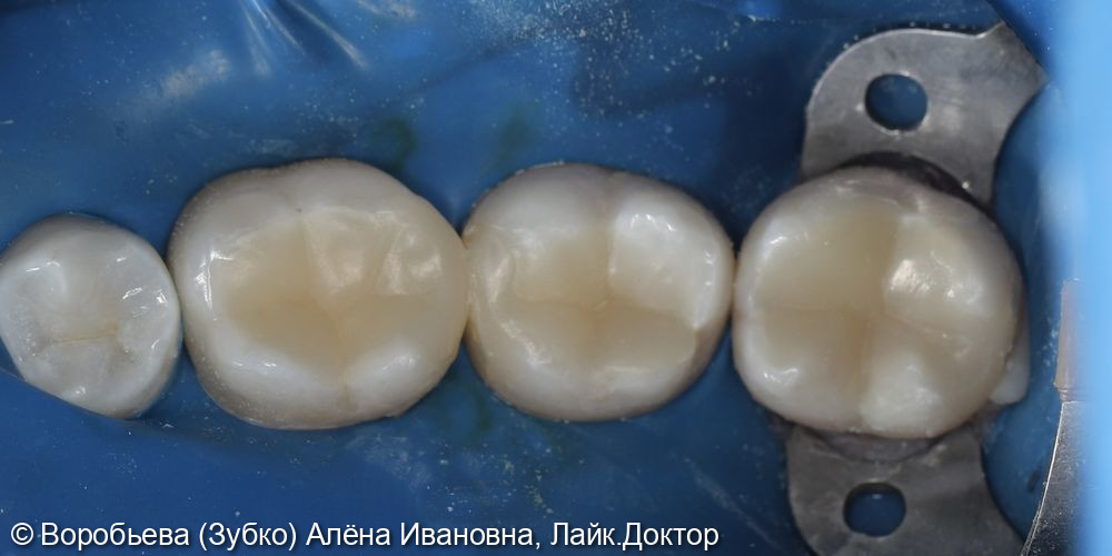 Лечение глубокого кариеса 46,47 и 48 зуба - фото №4