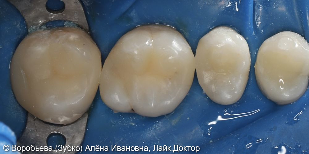 Лечение кариеса 26 и 27 зуба - фото №3