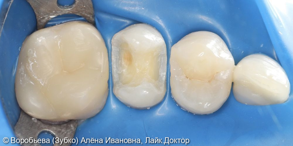 Лечение кариеса 25 и 24 зуба фото 2 · Вологда