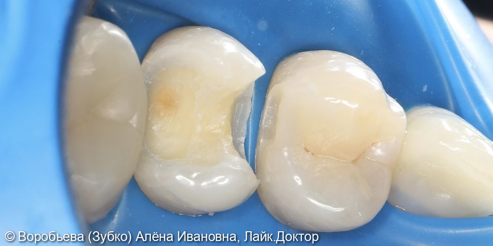 Лечение кариеса 25 и 24 зуба фото 3 · Вологда