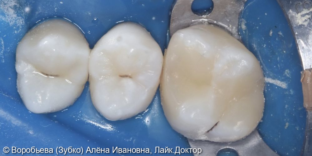 Лечение пульпита 16 пульпита - фото №4