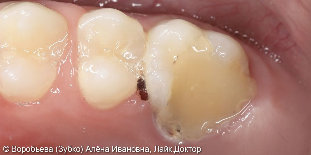 Лечение периодонтита 16 зуба - фото №1