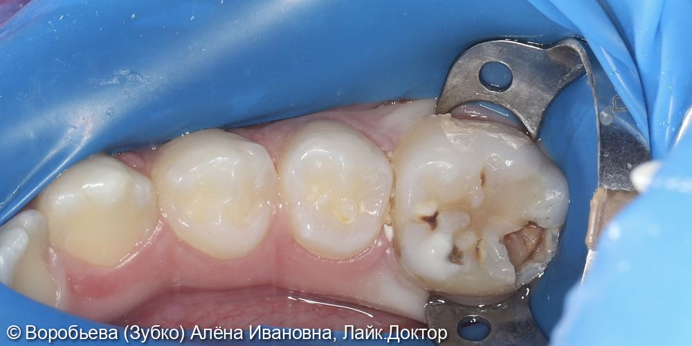 Лечение глубокого кариеса 47 зуба - фото №1