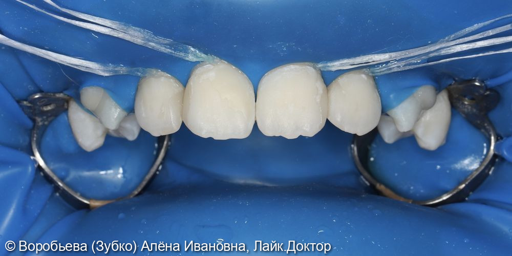 Лечение зубов айконом фото 2 · Вологда