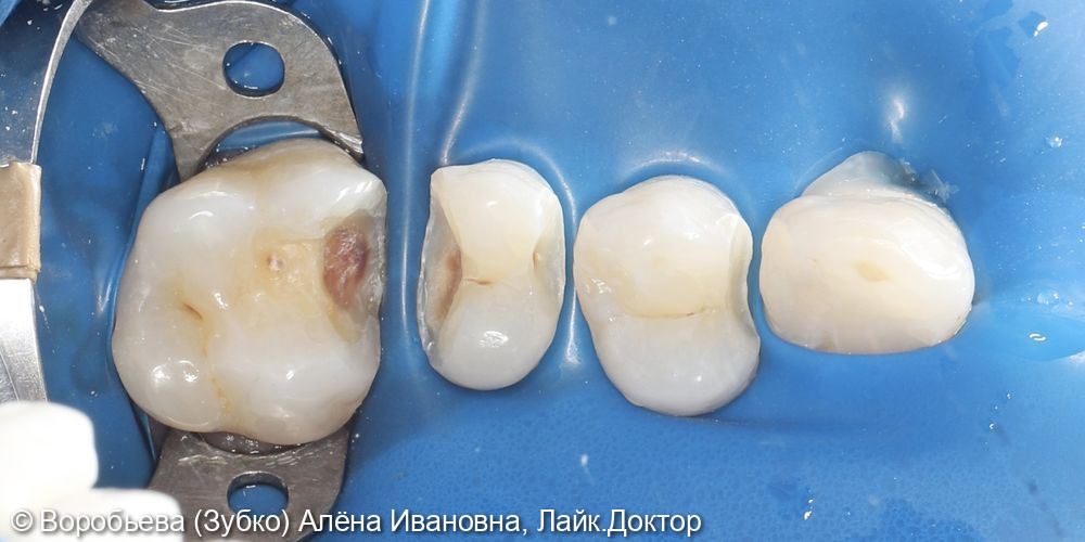 Лечение кариеса 26,25,24 зубов фото 2 · Вологда