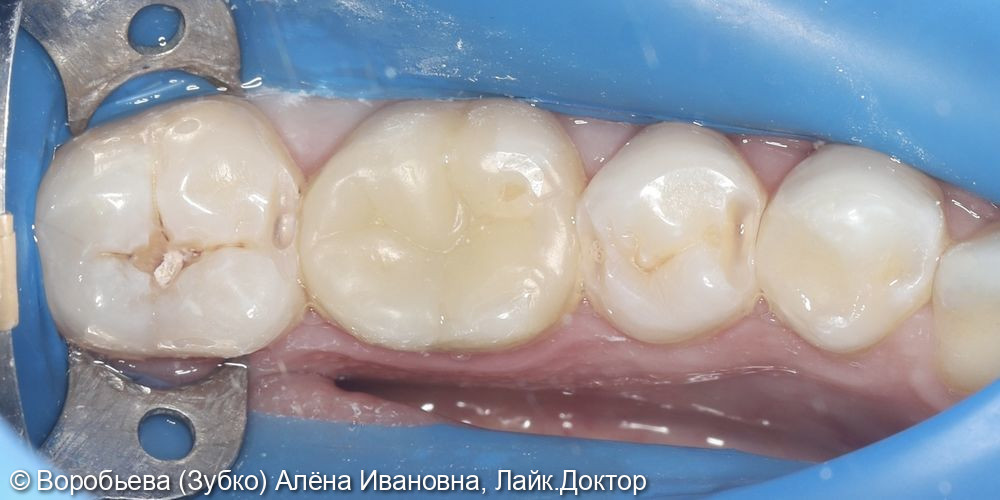 Лечение кариеса 37 и 35 зуба фото 2 · Вологда
