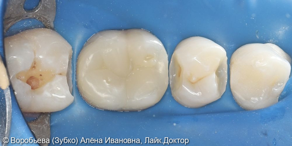 Лечение кариеса 37 и 35 зуба фото 3 · Вологда