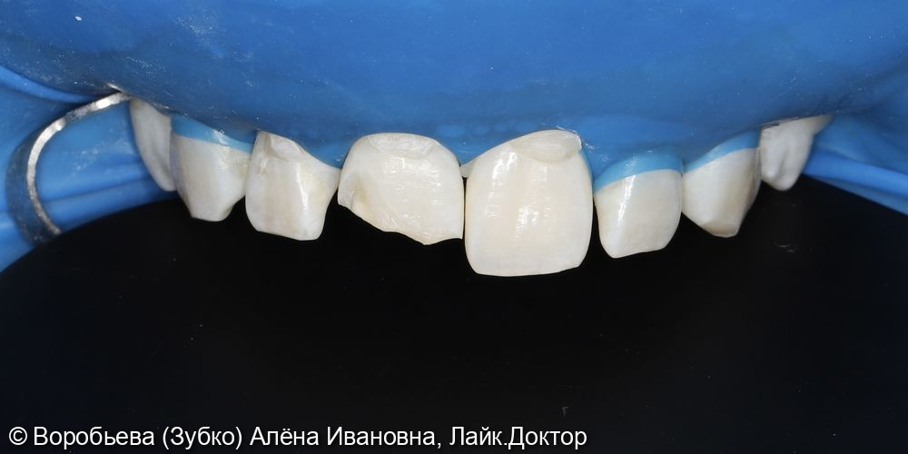 Лечение 11 зуба фото 2 · Вологда