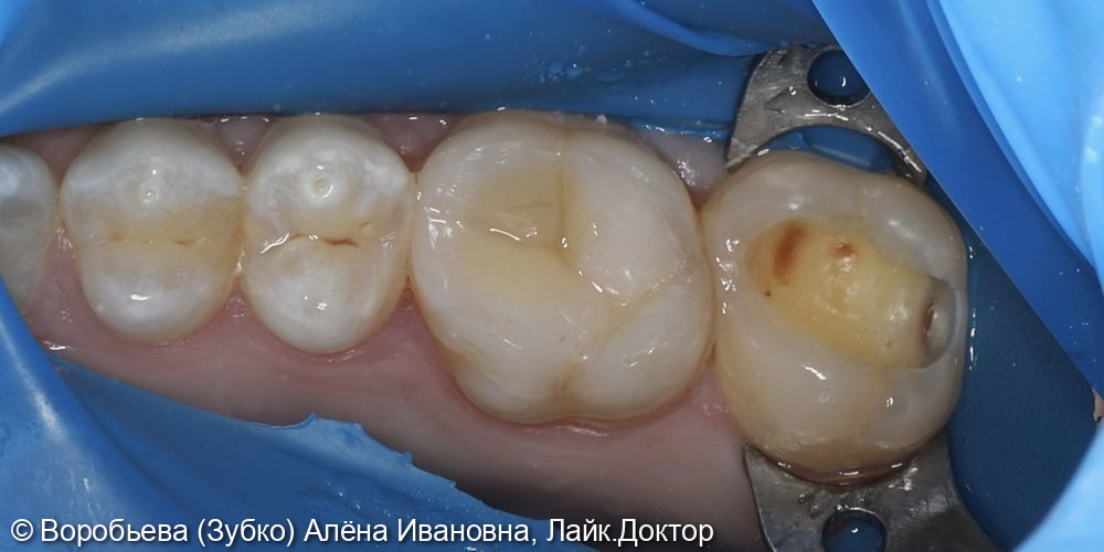 Лечение кариеса 17 зуба фото 2 · Вологда