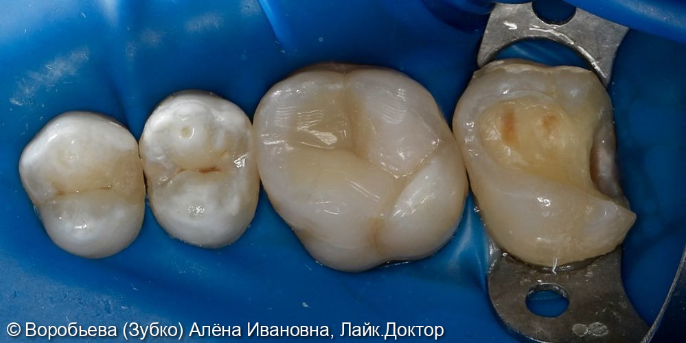 Лечение кариеса 17 зуба фото 3 · Вологда