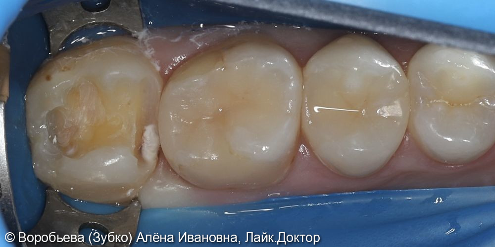 Лечение кариеса 27 зуба фото 2 · Вологда