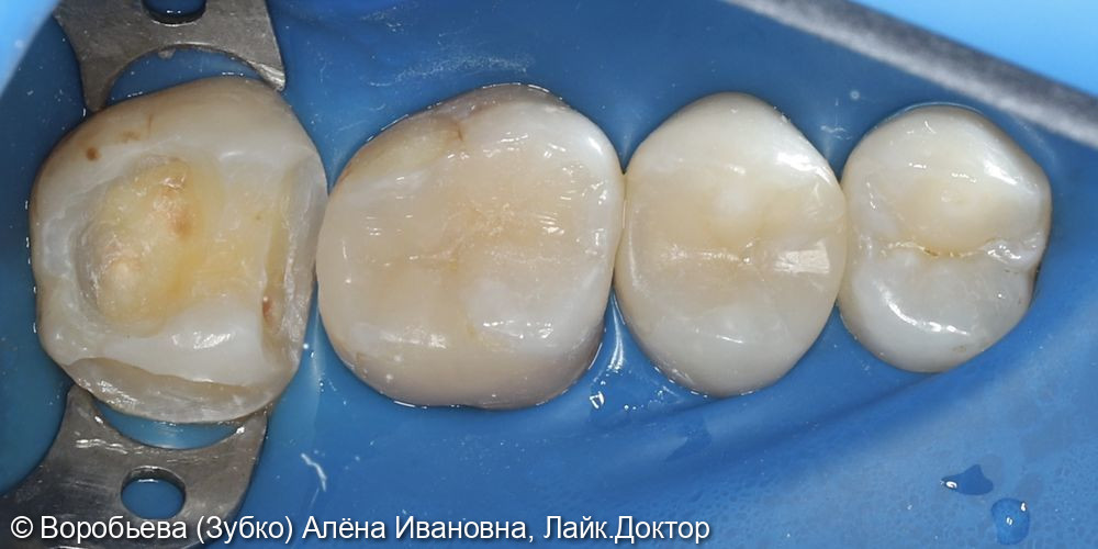 Лечение кариеса 27 зуба фото 3 · Вологда