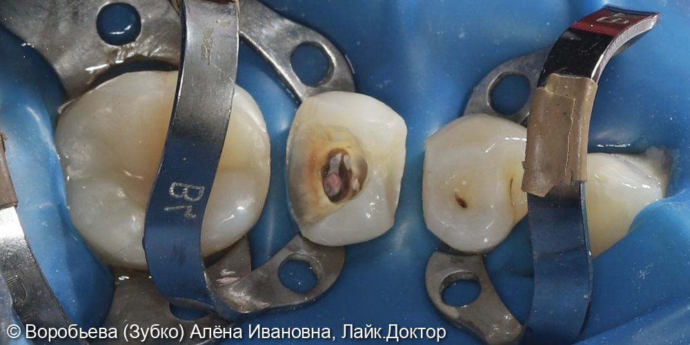 Лечение 35 и 44 зубов фото 2 · Вологда