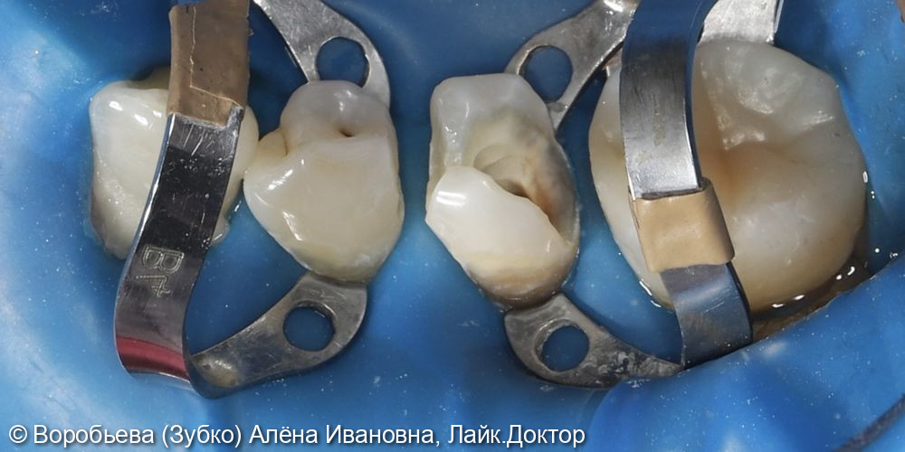 Лечение 35 и 44 зубов фото 3 · Вологда