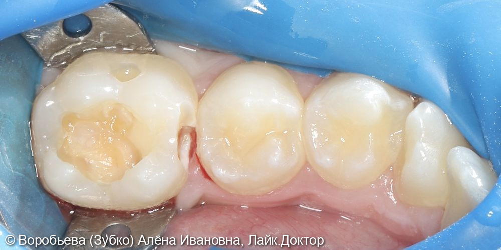 Лечение кариеса 35 и 36 зубов фото 2 · Вологда