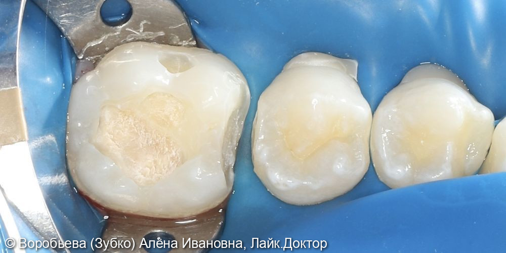 Лечение кариеса 35 и 36 зубов фото 3 · Вологда