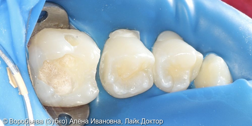 Лечение кариеса 35 и 36 зубов фото 4 · Вологда