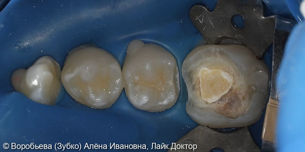 Лечение 45 и 46 зубов фото 2 · Вологда