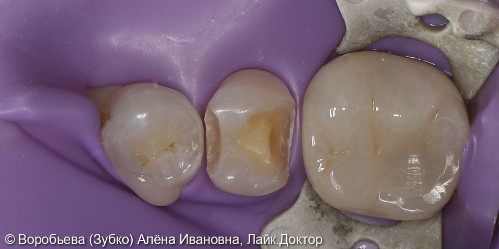 Лечение кариеса 45 зуба фото 2 · Вологда
