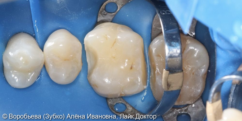 Лечение 16 и 17 зубов фото 2 · Вологда
