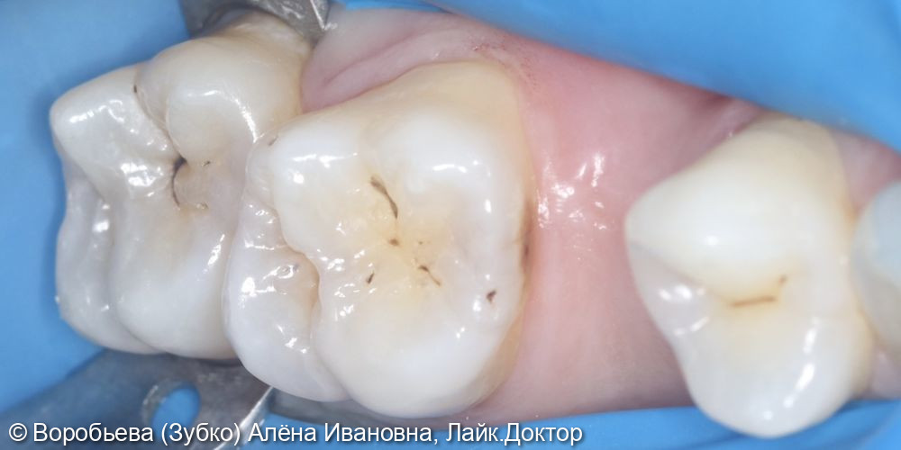 Лечение 26 и 27 зубов фото 2 · Вологда