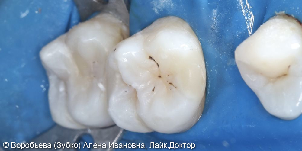 Лечение 26 и 27 зубов фото 5 · Вологда