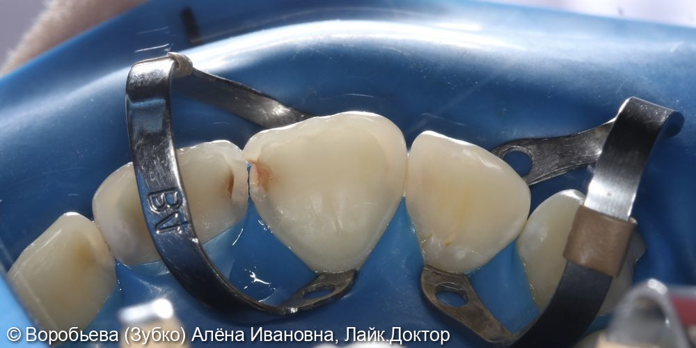 Лечение кариеса 11. И 12 зуба фото 2 · Вологда