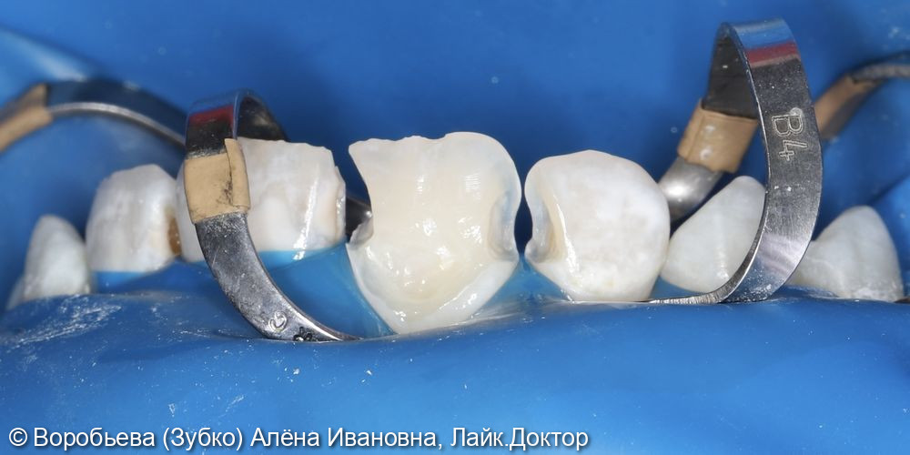 Лечение кариеса 11. И 12 зуба фото 3 · Вологда