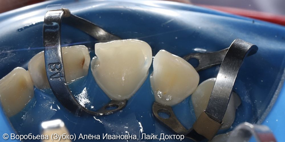 Лечение кариеса 11. И 12 зуба фото 4 · Вологда