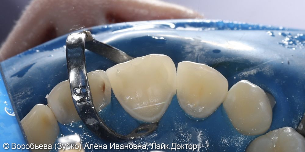 Лечение кариеса 11. И 12 зуба фото 5 · Вологда