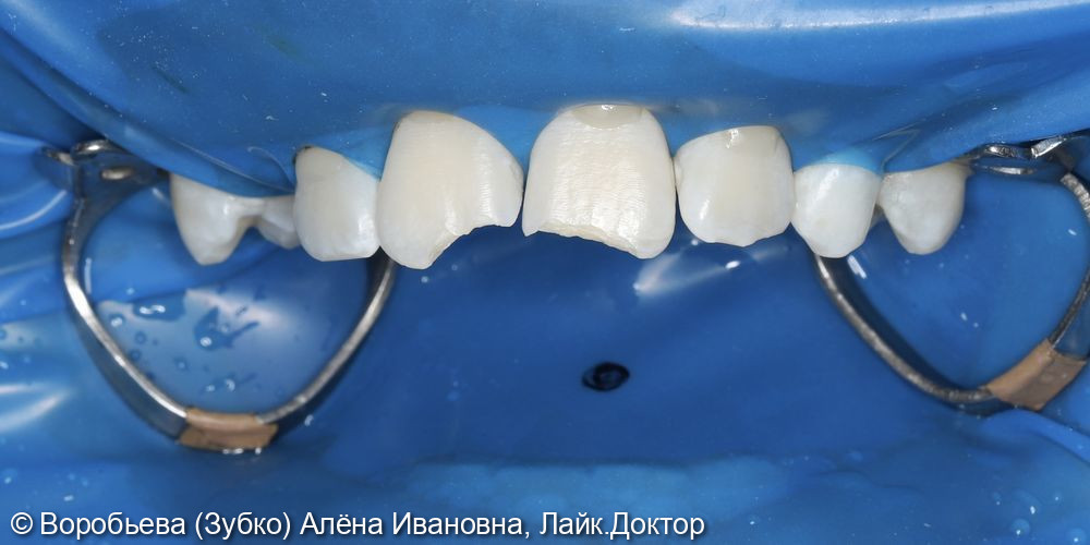 Реставрация 11 и 21 зубов - фото №1
