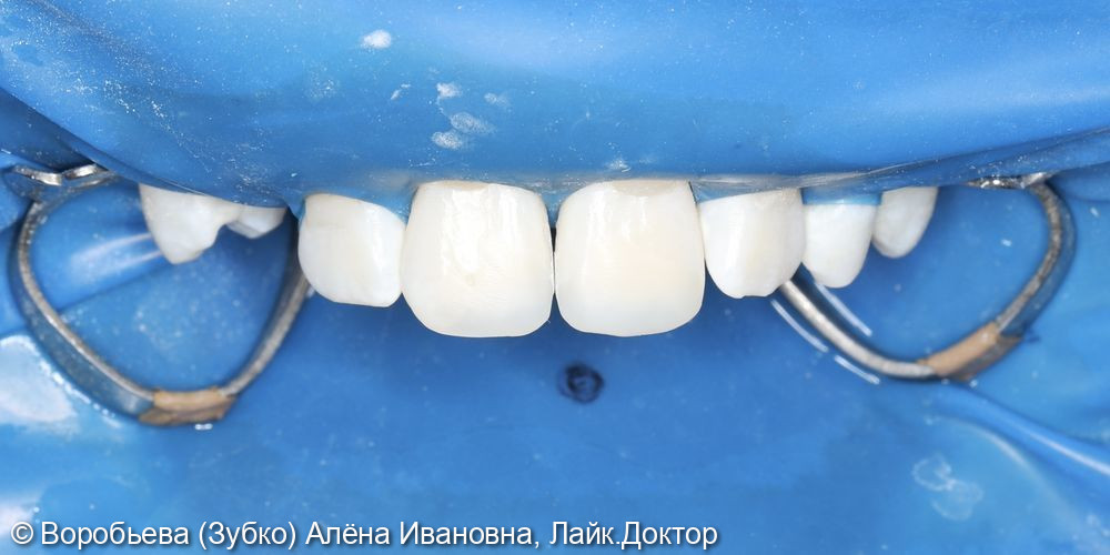 Реставрация 11 и 21 зубов - фото №4