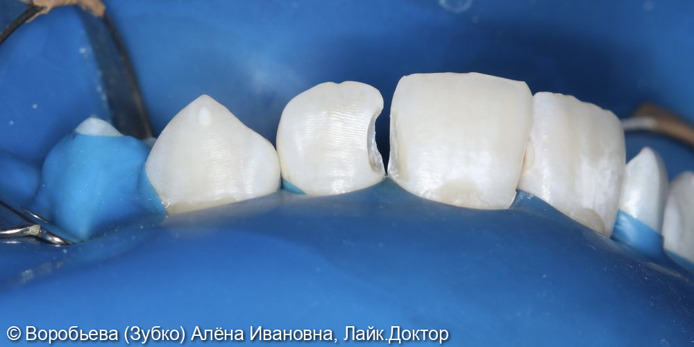 Лечение кариеса 21 и 22 зубов фото 2 · Вологда