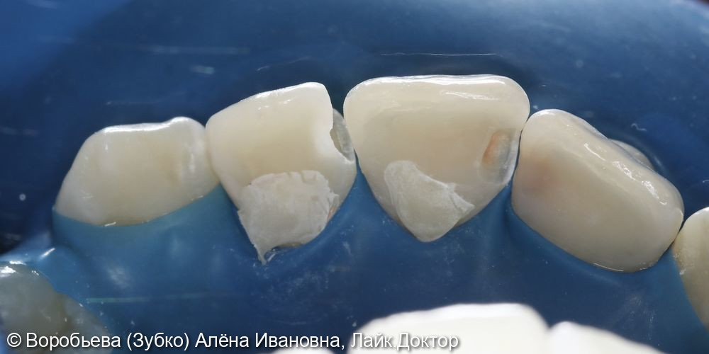 Лечение кариеса 21 и 22 зубов фото 3 · Вологда
