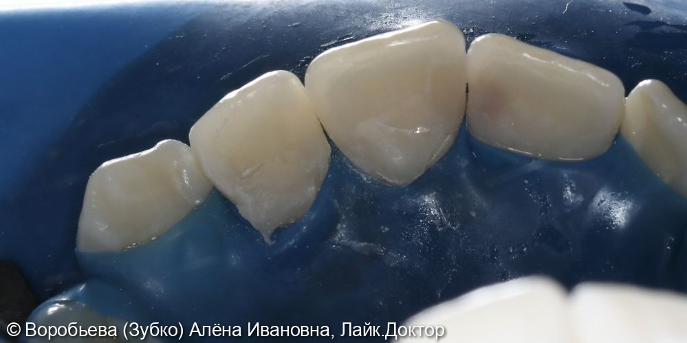 Лечение кариеса 21 и 22 зубов фото 4 · Вологда