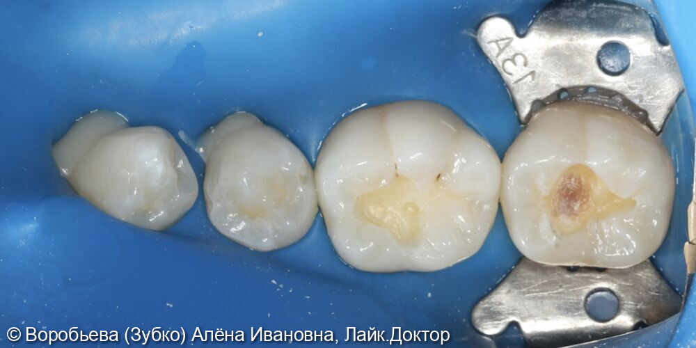 Лечение кариеса 46 и 47 фото 2 · Вологда