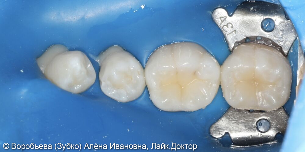 Лечение кариеса 46 и 47 - фото №3