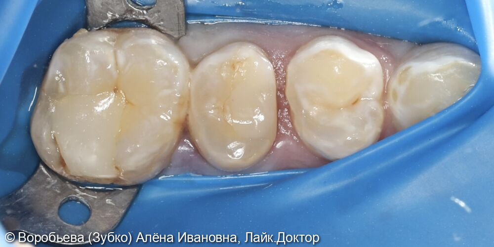 Лечение кариеса 24 зуба и периодонтита 25 зуба - фото №1