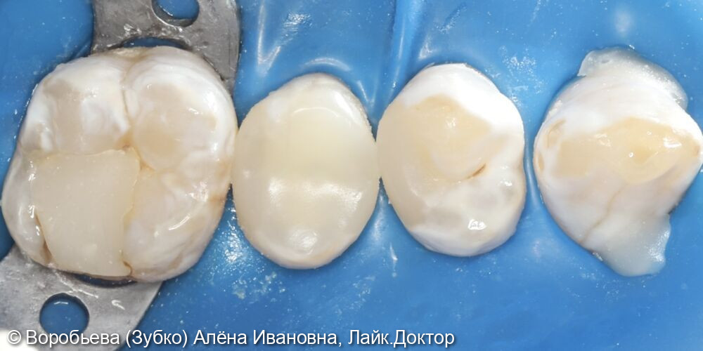 Лечение кариеса 24 зуба и периодонтита 25 зуба - фото №4