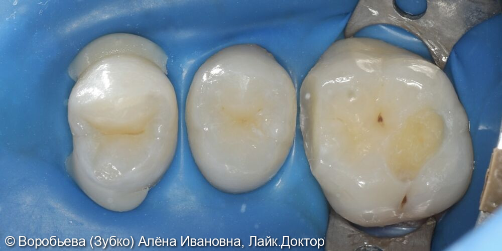 Лечение кариеса 16 зуба фото 3 · Вологда