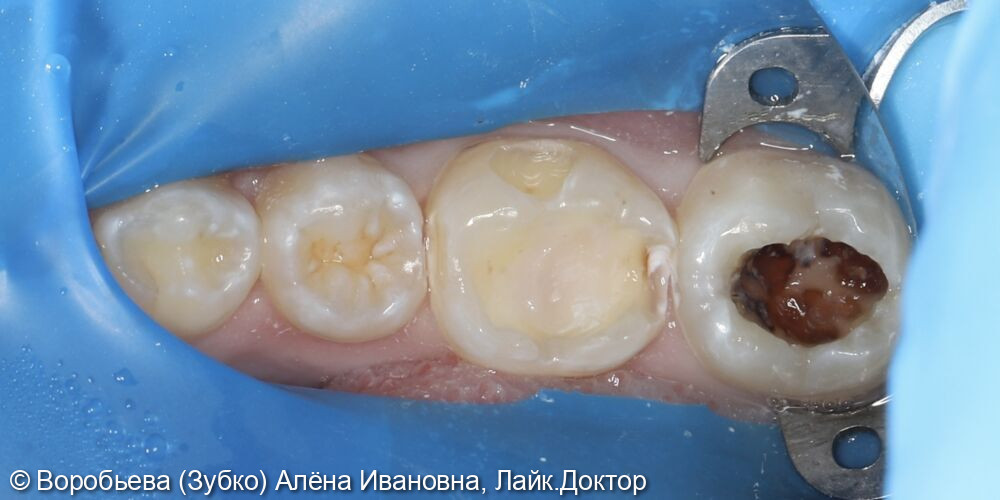 Лечение кариеса 47,46,45 зубов фото 2 · Вологда