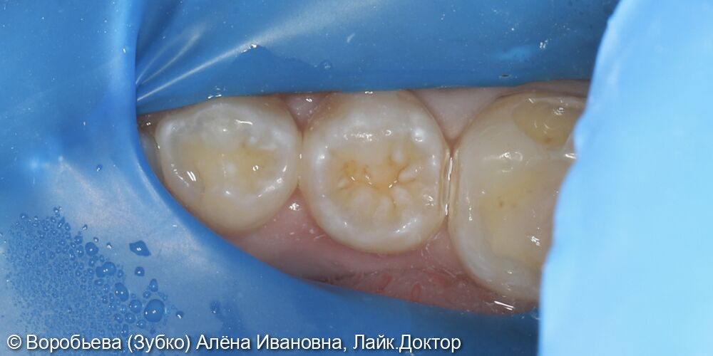 Лечение кариеса 47,46,45 зубов фото 3 · Вологда