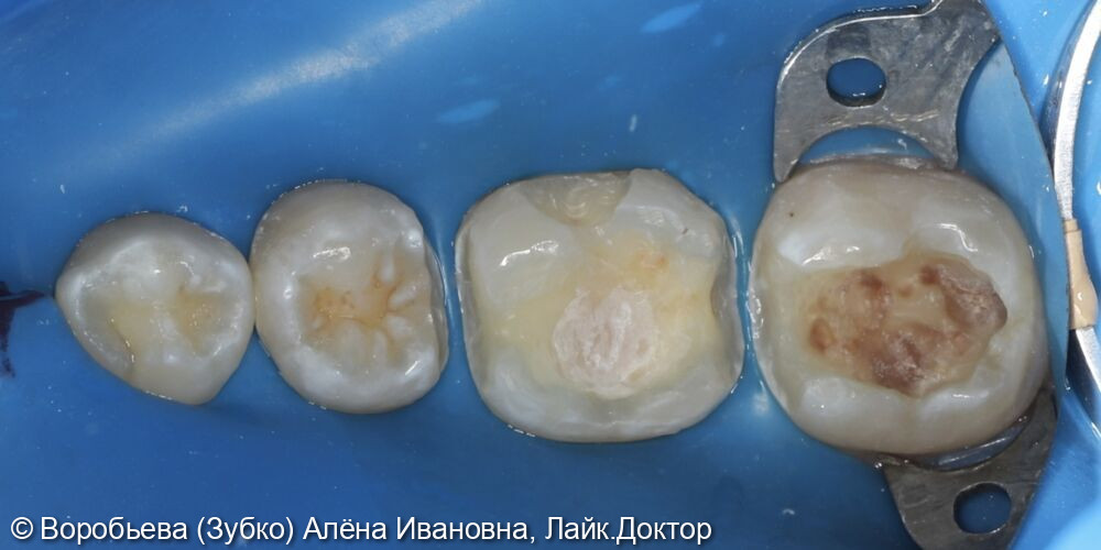 Лечение кариеса 47,46,45 зубов фото 4 · Вологда