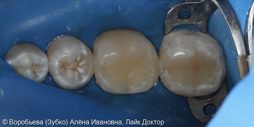 Лечение кариеса 47,46,45 зубов - фото №5