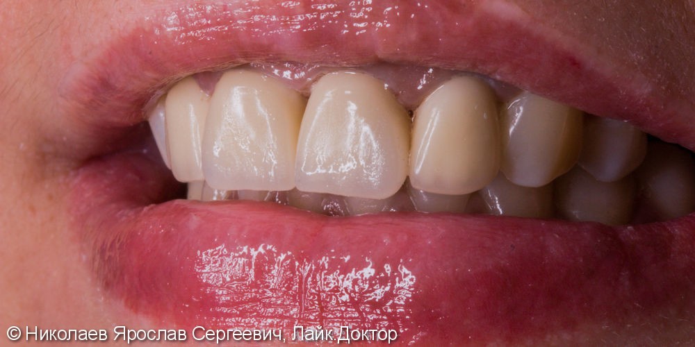 Эстетическая реабилитация фронтальной группы зубов. - фото №4