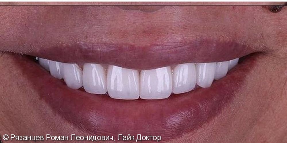Преобразование улыбки керамическими винирами, до и результат после - фото №2