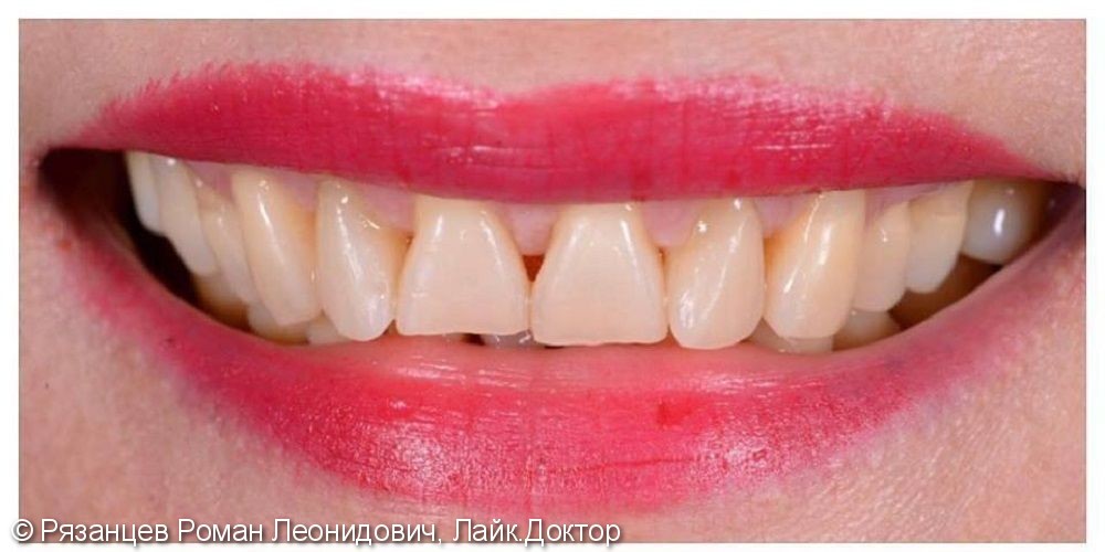 Форма и цвет зубов - это то, что чаще всего просят изменить пациенты. - фото №1